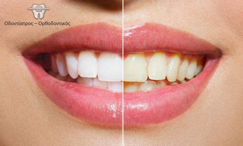 Λεύκανση δοντιών με υπέρυθρη ακτίνα σε μόλις 60 λεπτά, για ένα λαμπερό χαμόγελο στο Παλαιό Φάληρο
